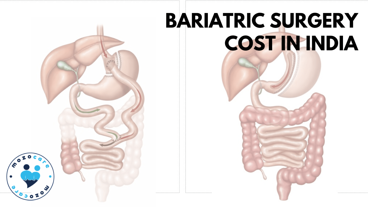 Bariatric Surgery Cost in India