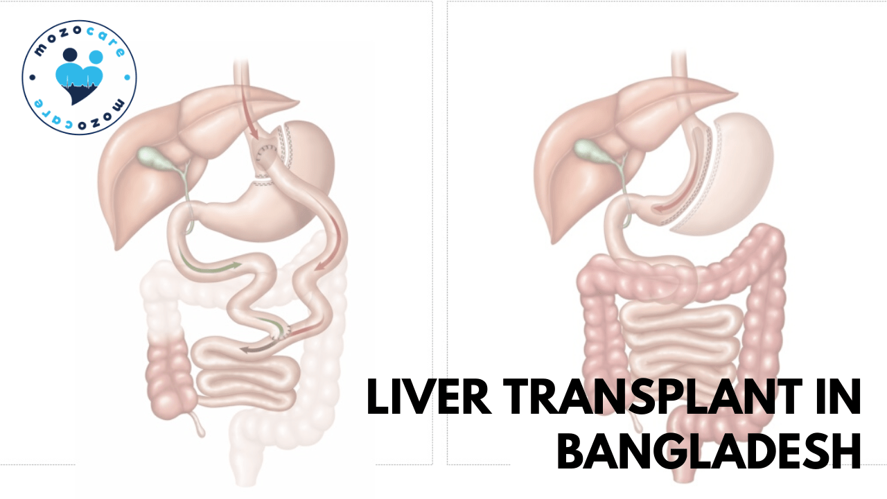 Liver Transplant In Bangladesh