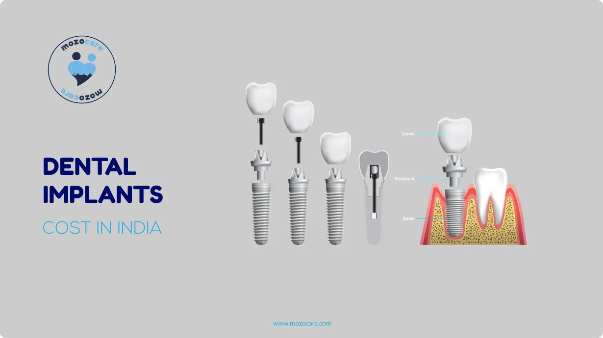 Dental-Implant-Cost-In-India