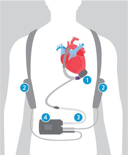 LVAD ( Left Ventricular Assisting Device) Bridge To Heart Transplant